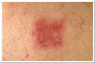 Eczema Picture Patch Testing 