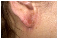 Eczema Picture Allergic Contact Dermatitis to nickel
