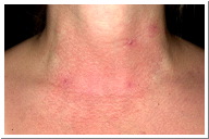 Eczema pictures Allergic Contact eczema to perfume
