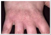 Eczema picture irritant eczema of the hand 