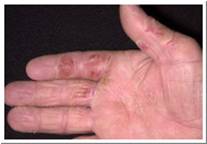 Eczema Pictures Hand Eczema