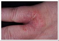 Eczema Pictures -  Eczema of the hand