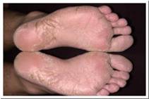 Eczema pictures atopic eczema of feet.jpg