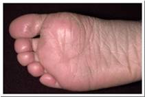 Eczema Pictures - Eczema Fissures on feet.jpg