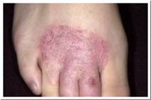 Eczema Pictures - Chronic eczema of the foot.jpg