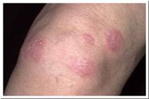 Eczema Pictures - Nummular Eczema of Knee