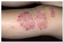 Eczema Pictures - Nummular Eczema of leg