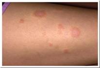 Eczema pictures nummular eczema on leg