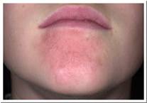 Eczema Picture Subacute Irritant Eczema.jpg