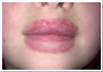 Eczema Pictures Irritant Eczema on Lips.jpg
