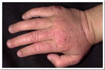 Eczema pictures - child with atopic eczema on hand