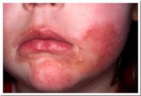 Eczema Pictures - Child with Atopic eczema on face