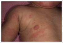 Eczema Pictures Child with atopic eczema on body